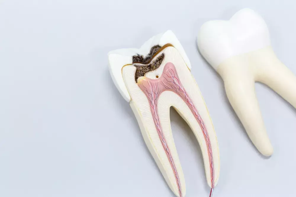 歯髄保存療法とは