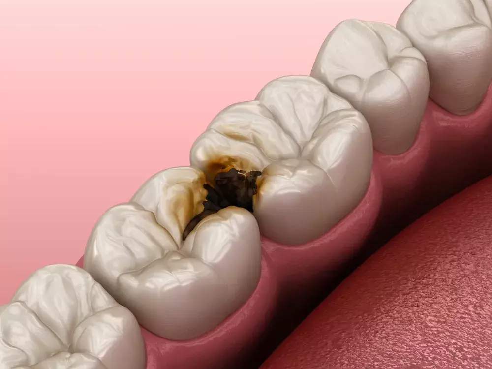 根管治療で歯の神経を取る場合について